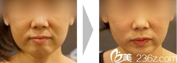 池田欣生面部埋線提升前后對比 池田欣生面部埋線提升前后對比