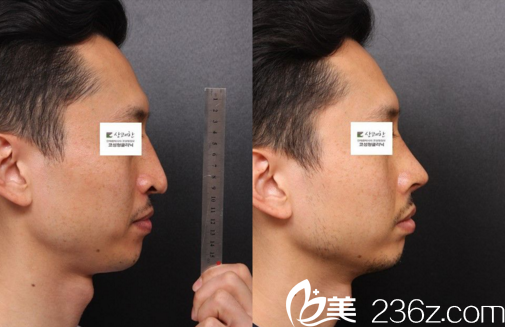 鼻整形真人前后對比效果 鼻整形真人前后對比效果