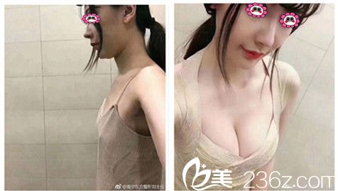 南寧東方趙波隆胸變化圖