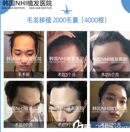 韓國(guó)江南NHI植發(fā)醫(yī)院毛發(fā)移植案例 韓國(guó)江南NHI植發(fā)醫(yī)院毛發(fā)移植案例