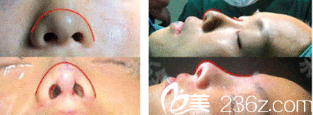 隆鼻真人示意圖