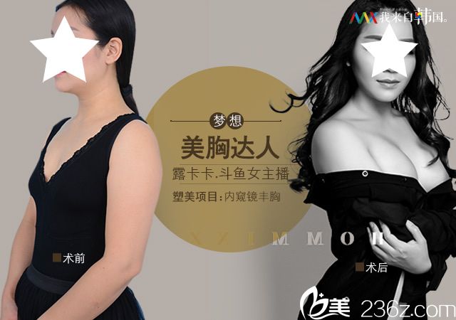 南寧夢(mèng)想整形內(nèi)窺鏡隆胸案例