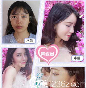 煙臺洛神隆鼻案例