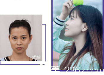 煙臺華怡隆鼻案例