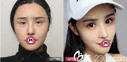 北京美萊雙眼皮修復案例