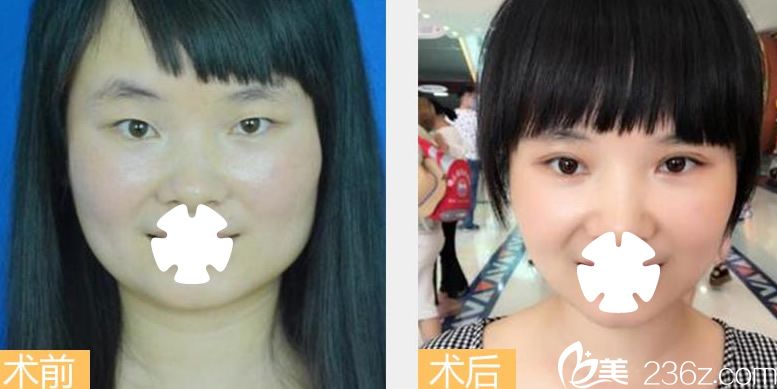 南寧夢(mèng)想整形雙眼皮加開眼角案例圖