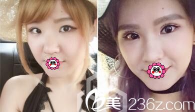 中國臺灣首席整形混血瞳手術案例 中國臺灣首席整形混血瞳手術案例