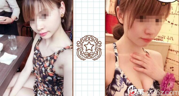 勇中華自體脂肪隆胸案例效果前后對(duì)比