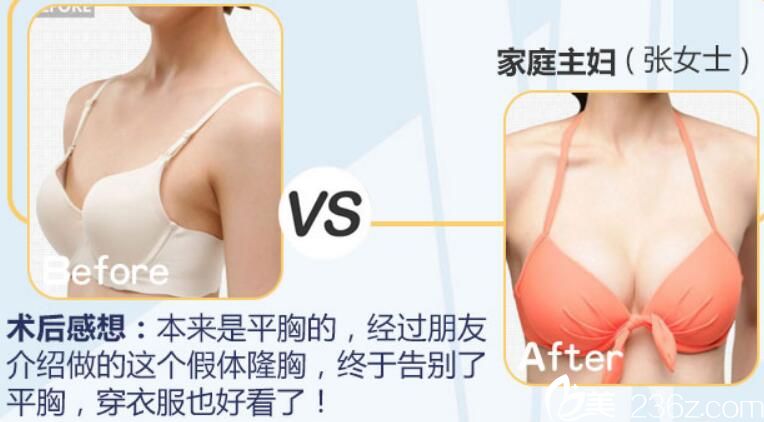 阜陽東方美萊塢整形假體隆胸術(shù)前術(shù)后對(duì)比案例
