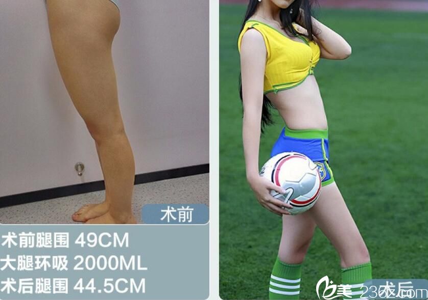 找阜陽東方美萊塢勇中華做大腿吸脂案例前后效果對(duì)比圖