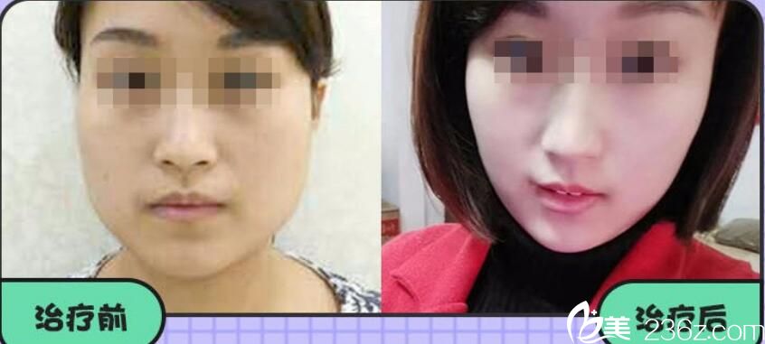 阜陽美萊塢瘦臉案例前后效果對(duì)比照片