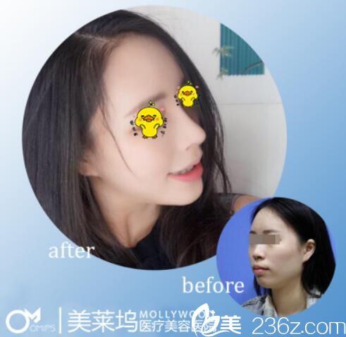 阜陽美萊塢安全？看隆鼻案例及顧客反饋