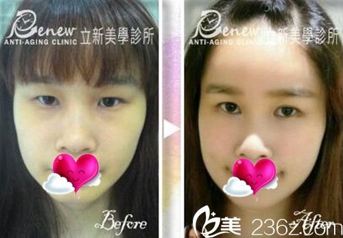 中國臺(tái)灣邱維誠做的自體脂肪填充面部對(duì)比圖