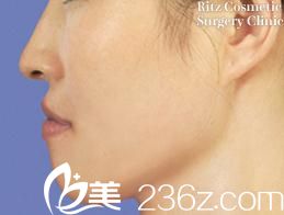 日本Ritz(廣比利次)美容外科醫(yī)院下顎前凸削骨手術(shù)前 日本Ritz(廣比利次)美容外科醫(yī)院下顎前凸削骨手術(shù)前