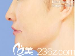 用我自己的經歷講講廣比利次醫(yī)生做的下顎前凸臉部削骨手術，附前后對比效果圖