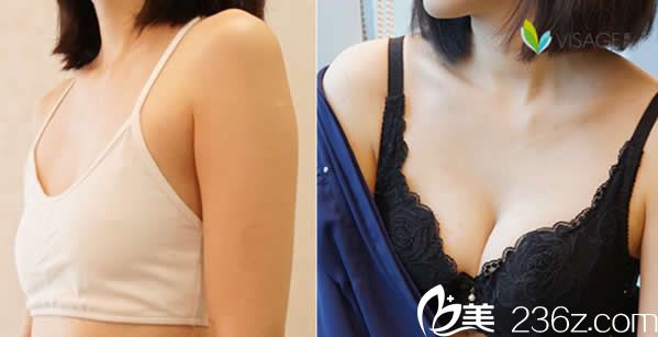 中國臺灣慕顏整形余德毅內窺鏡隆胸效果案例 中國臺灣慕顏整形余德毅內窺鏡隆胸效果案例