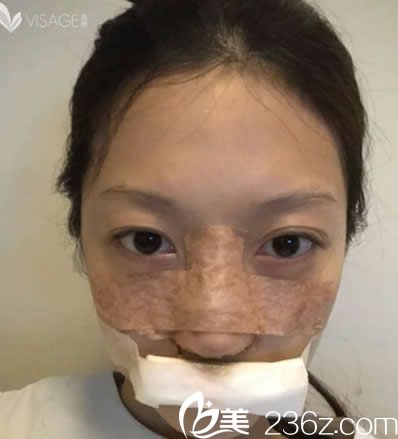 臺(tái)北慕顏假體隆鼻+耳軟骨墊鼻尖天