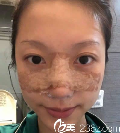 鼻綜合隆鼻第二天效果