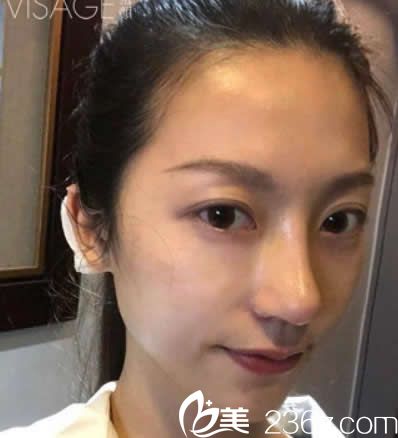 臺(tái)北慕顏整形鼻綜合隆鼻第七天拆線后