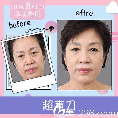 汕頭華美田學勤治療案例