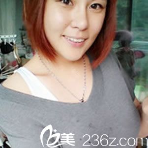 做完假體和脂肪隆胸8天恢復(fù)照 做完假體和脂肪隆胸8天恢復(fù)照