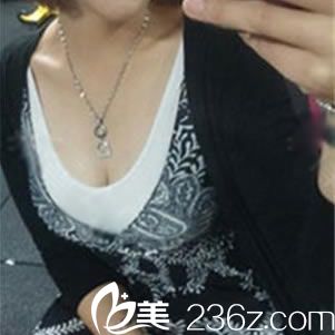 在紹興藝美整形這花3W多做假體和自體脂肪復(fù)合隆胸的這半年時間里,沒一天后悔過