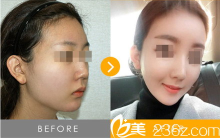 韓國TOP整形外科面部吸脂真人照片