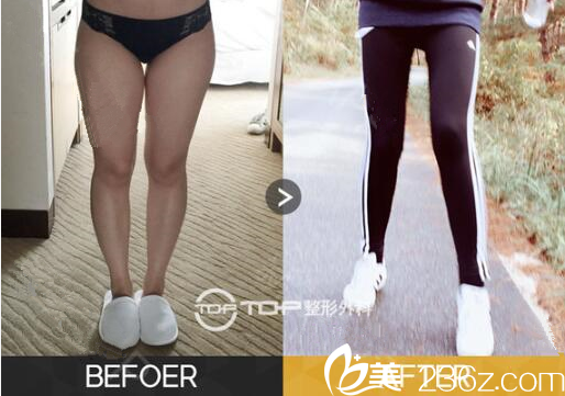 韓國TOP整形外<!--<i data=20240703-sp></i>-->腿吸脂對(duì)比照片