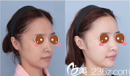 韓國(guó)媄琳皮膚整形醫(yī)院崔濬自體脂肪面部填充真人案例 韓國(guó)媄琳皮膚整形醫(yī)院崔濬自體脂肪面部填充真人案例