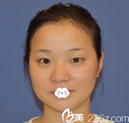 武漢壹加壹李艷東雙眼皮真人案例 武漢壹加壹李艷東雙眼皮真人案例