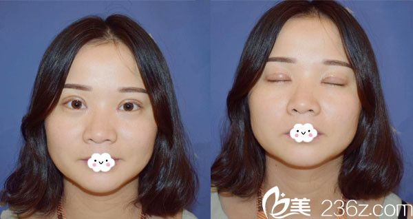 武漢壹加壹李艷東雙眼皮+開(kāi)眼角術(shù)后7天效果 武漢壹加壹李艷東雙眼皮+開(kāi)眼角術(shù)后7天效果