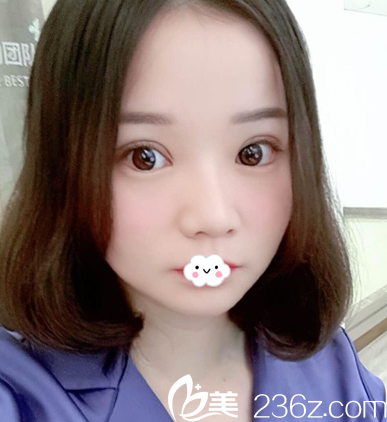 武漢壹加壹雙眼皮術(shù)后1月恢復(fù)照片 武漢壹加壹雙眼皮術(shù)后1月恢復(fù)照片