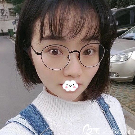 武漢壹加壹雙眼皮真人案例術(shù)后效果圖 武漢壹加壹雙眼皮真人案例術(shù)后效果圖