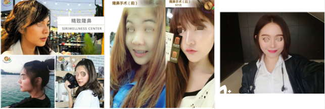 泰國SiriWellness Center（思麗）隆鼻案例