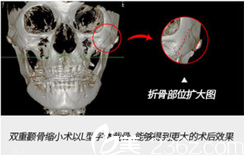 顴骨部位擴(kuò)大圖 顴骨部位擴(kuò)大圖