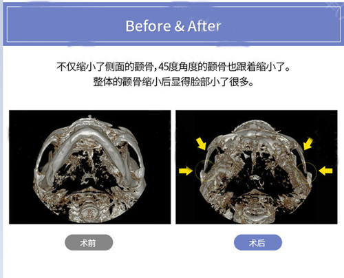 顴骨縮小手術(shù)前后對(duì)比 顴骨縮小手術(shù)前后對(duì)比