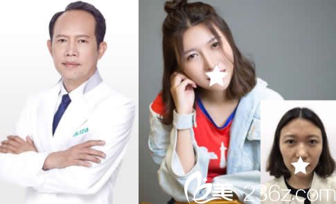 廣西愛思特黎凍鼻整形失敗修復案例