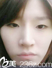 我在<!--<i data=20240703-sp></i>-->做雙眼皮術(shù)前照片 我在<!--<i data=20240703-sp></i>-->做雙眼皮術(shù)前照片