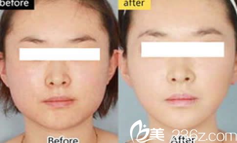 南寧愛思特面部吸脂10天恢復效果圖