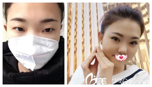 想在2019年提前超值變美 來看石家莊天伊美內(nèi)含880元雙眼皮的優(yōu)惠價格表