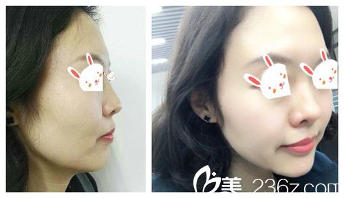 石家莊天伊美做隆鼻案例 石家莊天伊美做隆鼻案例