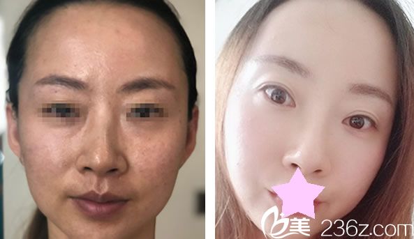 趙宏遠面部線雕提升效果對比圖 趙宏遠面部線雕提升效果對比圖