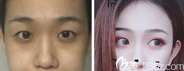 潘貳做眼綜合+全切雙眼皮效果對比圖 潘貳做眼綜合+全切雙眼皮效果對比圖