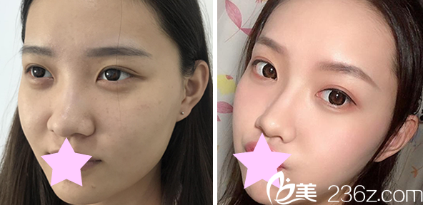 周誠主任做鼻綜合+耳軟骨隆鼻效果對比圖 周誠主任做鼻綜合+耳軟骨隆鼻效果對比圖