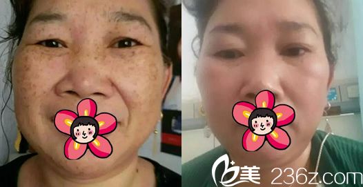 義烏連天美皮秒激光祛斑<span style= 義烏連天美皮秒激光祛斑<span style=