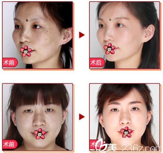 義烏連天美激光祛斑<span style= 義烏連天美激光祛斑<span style=