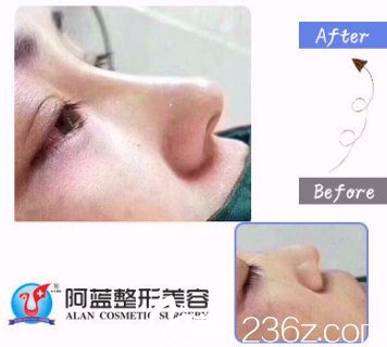 <!--<i data=20240703-sp></i>-->鼻綜合術后效果對比 <!--<i data=20240703-sp></i>-->鼻綜合術后效果對比