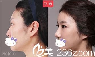 雙眼皮加隆鼻手術效果圖 雙眼皮加隆鼻手術效果圖