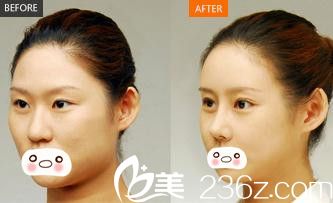 信陽易韓安和美容整形醫(yī)院雙眼皮手術效果圖 信陽易韓安和美容整形醫(yī)院雙眼皮手術效果圖