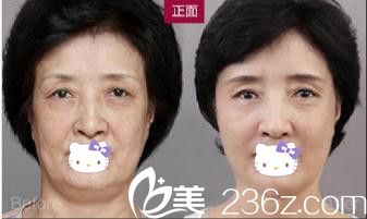 張院長自體脂肪填充心形臉案例二 張院長自體脂肪填充心形臉案例二